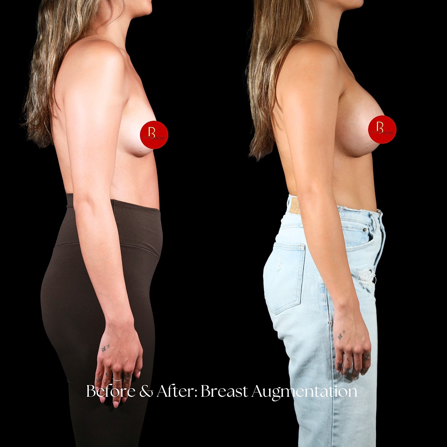 Breast Augmentation Before & After