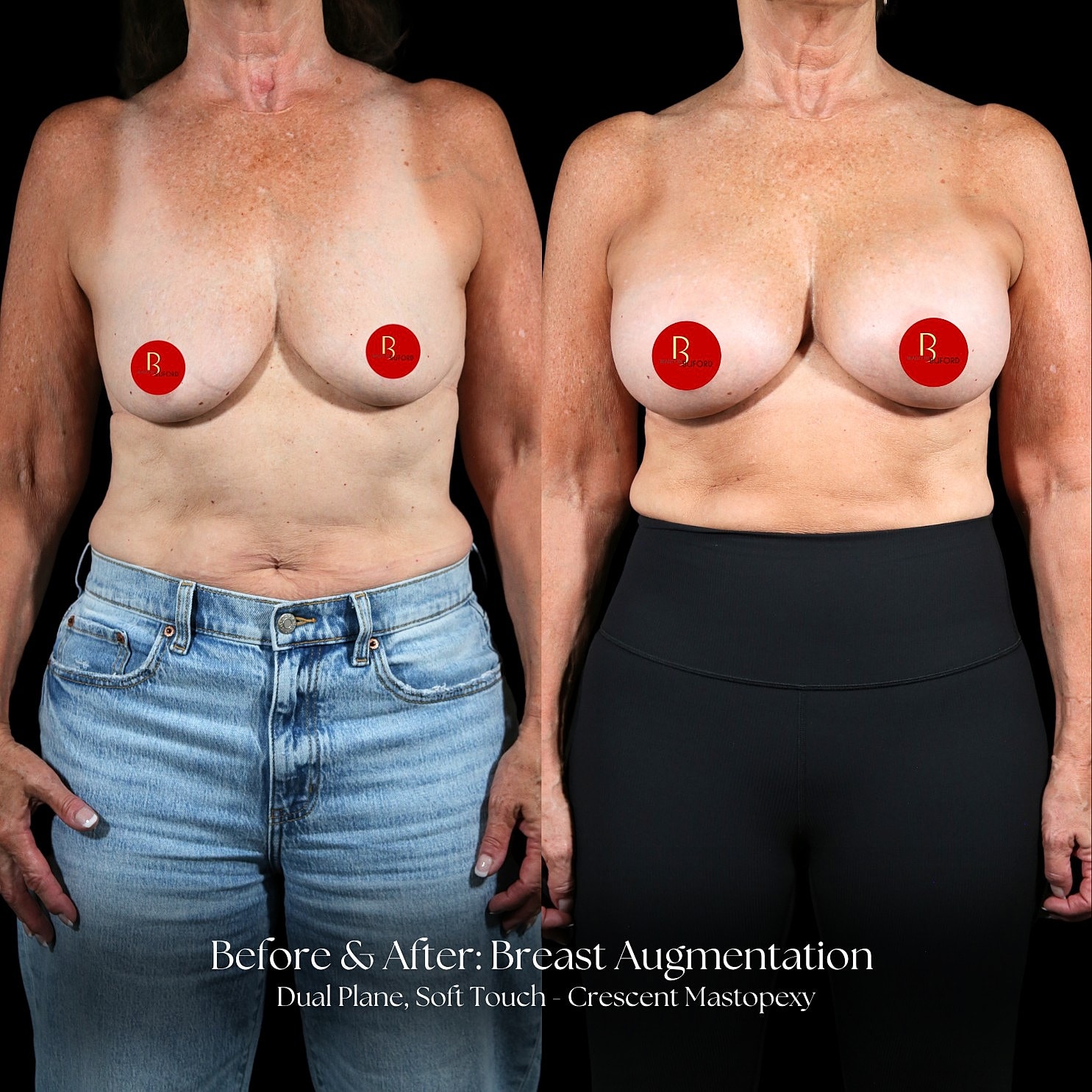 Breast Augmentation Before & After