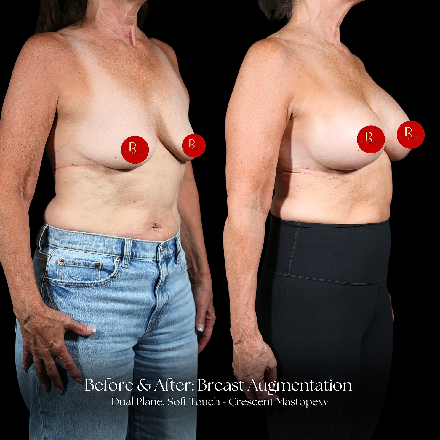 Breast Augmentation Before & After