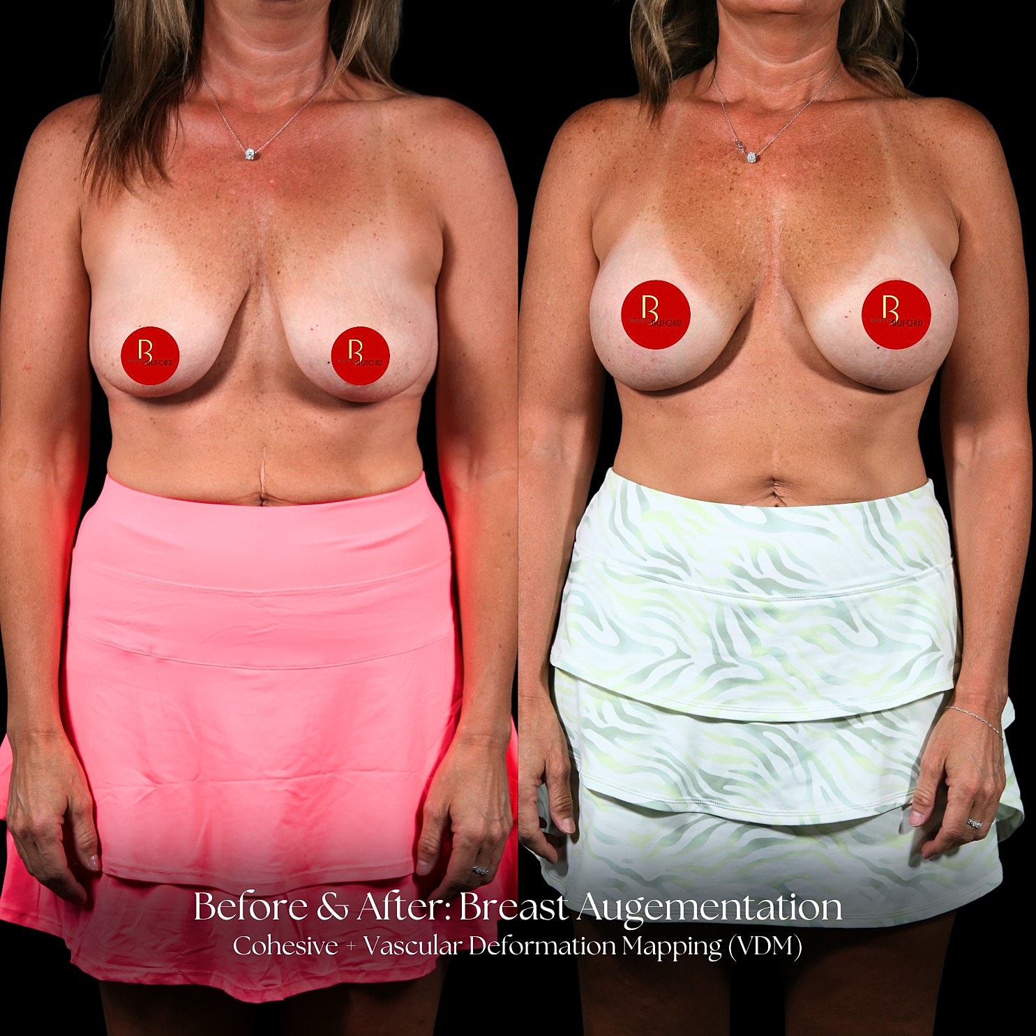 Breast Augmentation Before & After