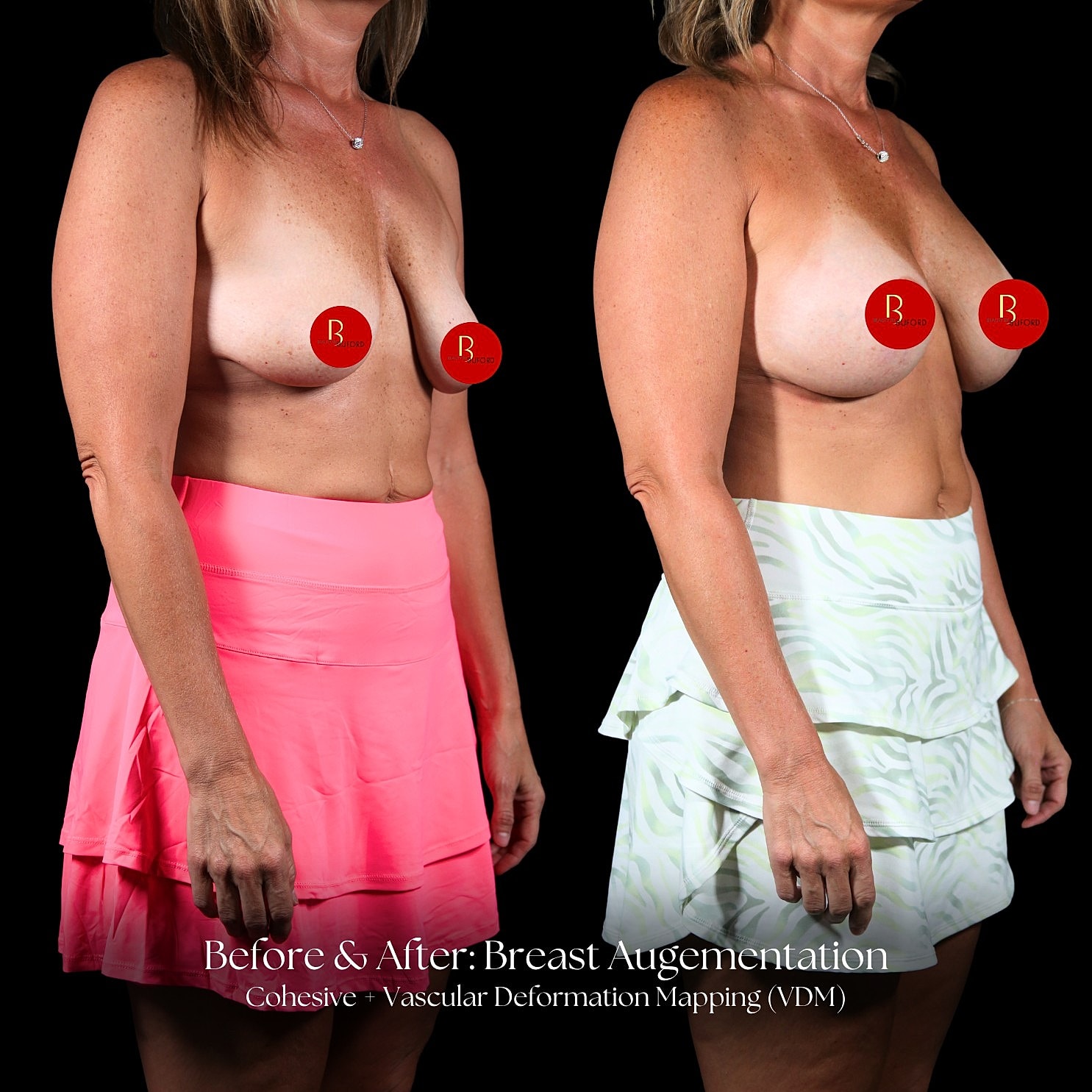 Breast Augmentation Before & After