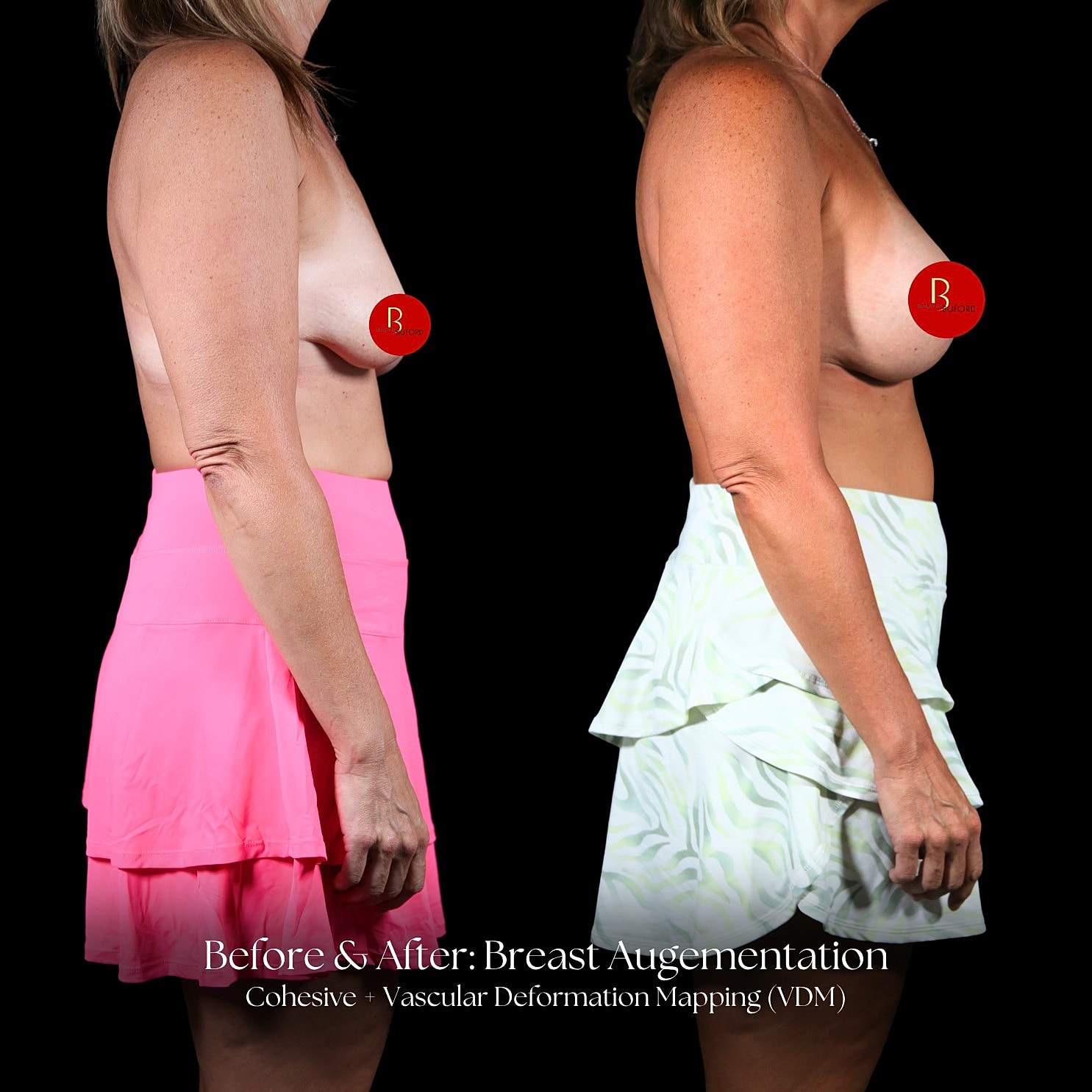 Breast Augmentation Before & After