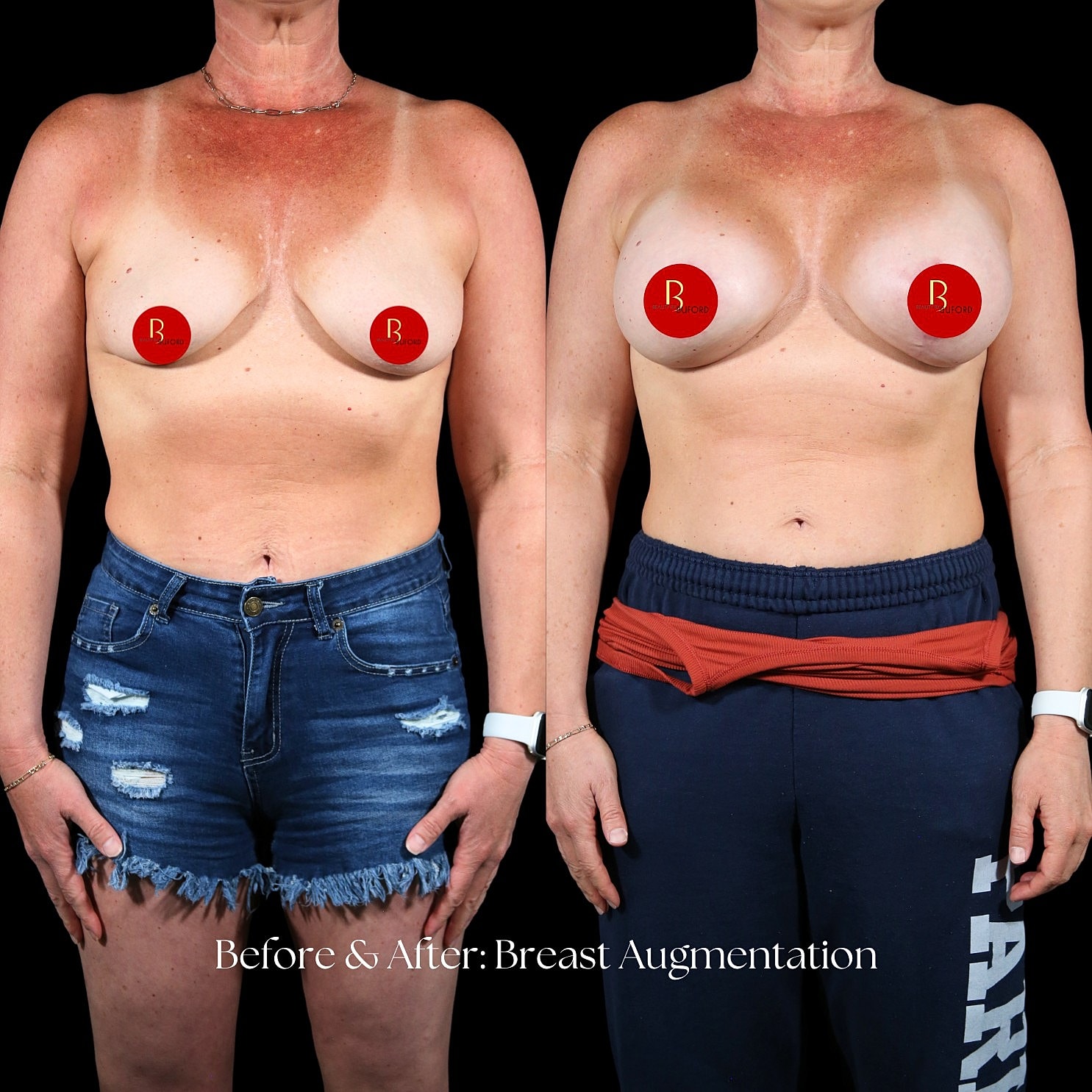 Breast Augmentation Before & After