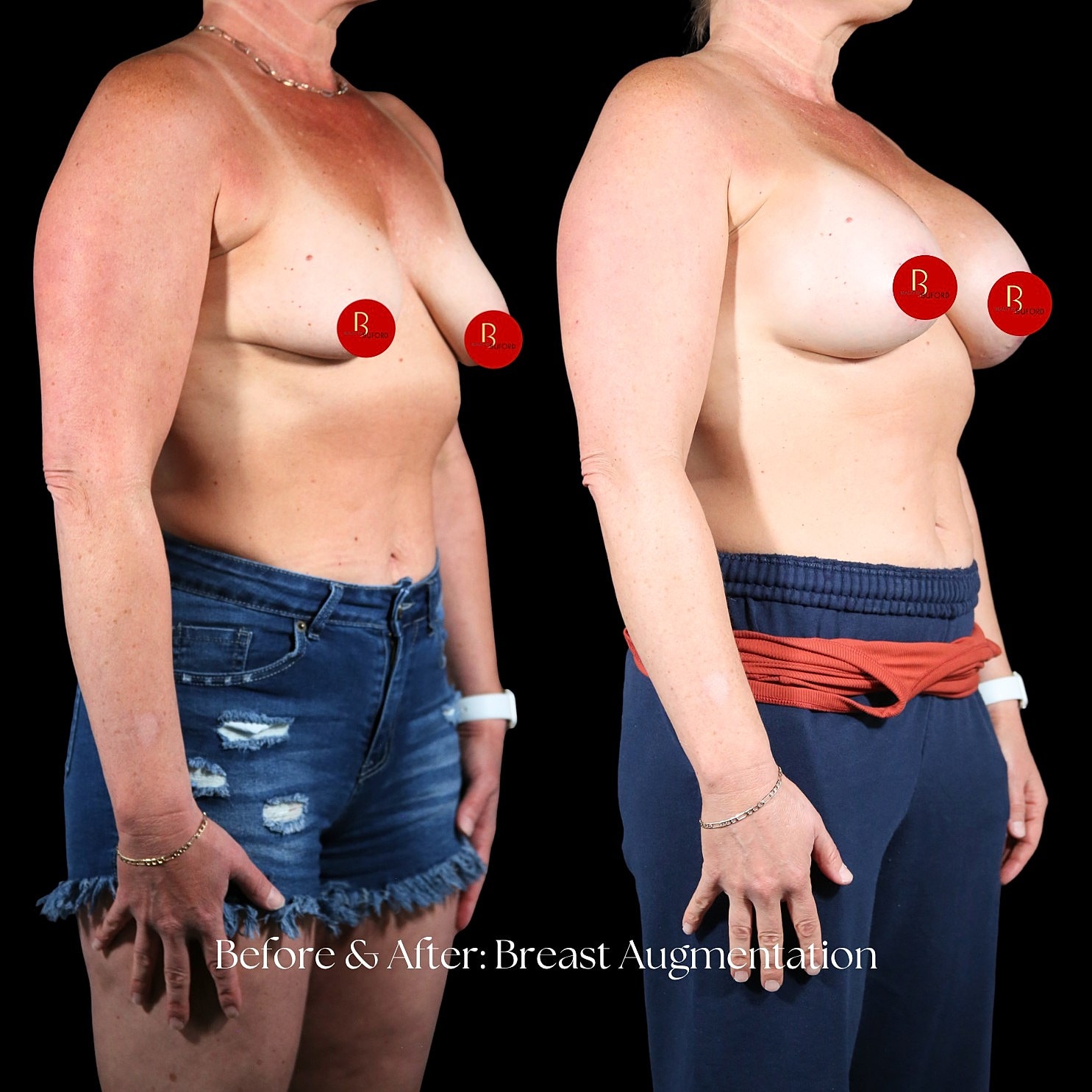 Breast Augmentation Before & After