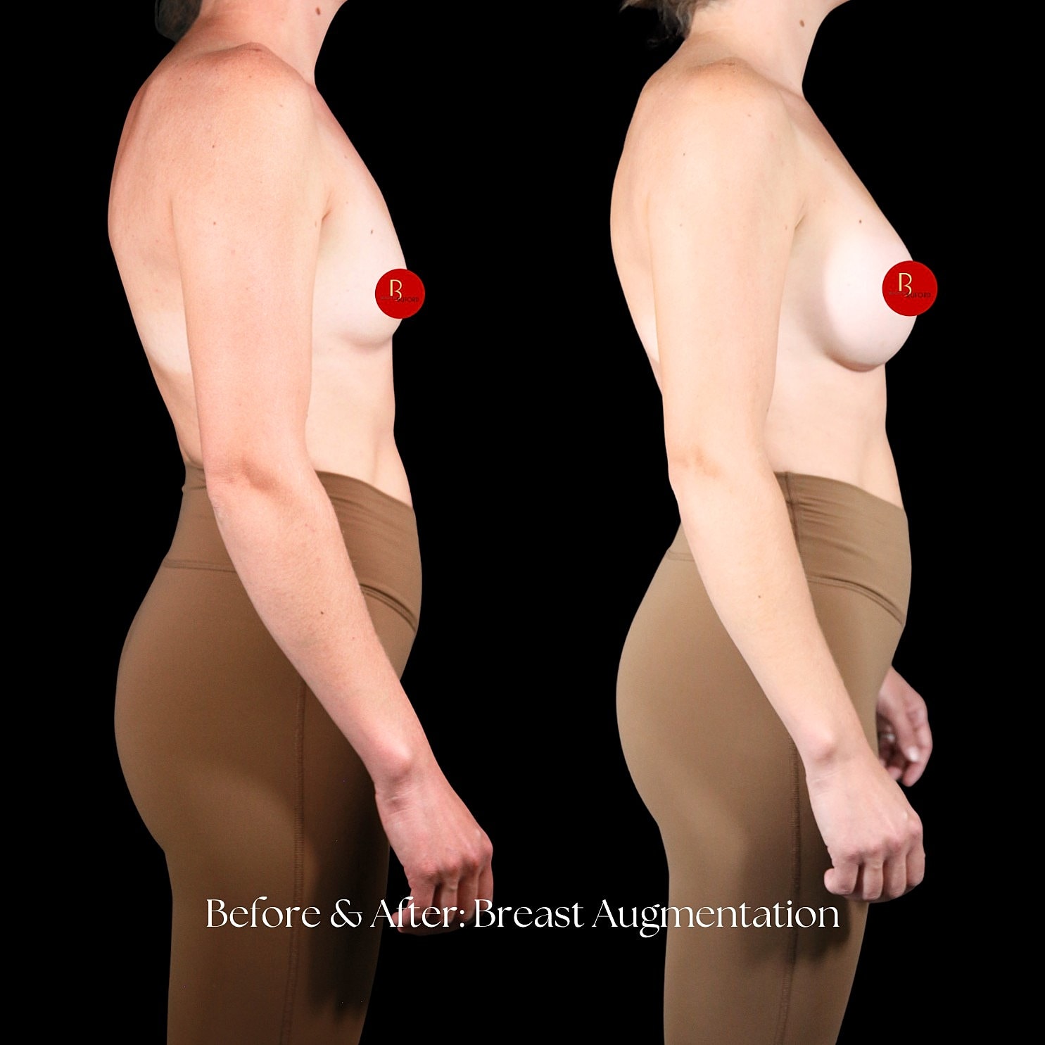 Breast Augmentation Before & After