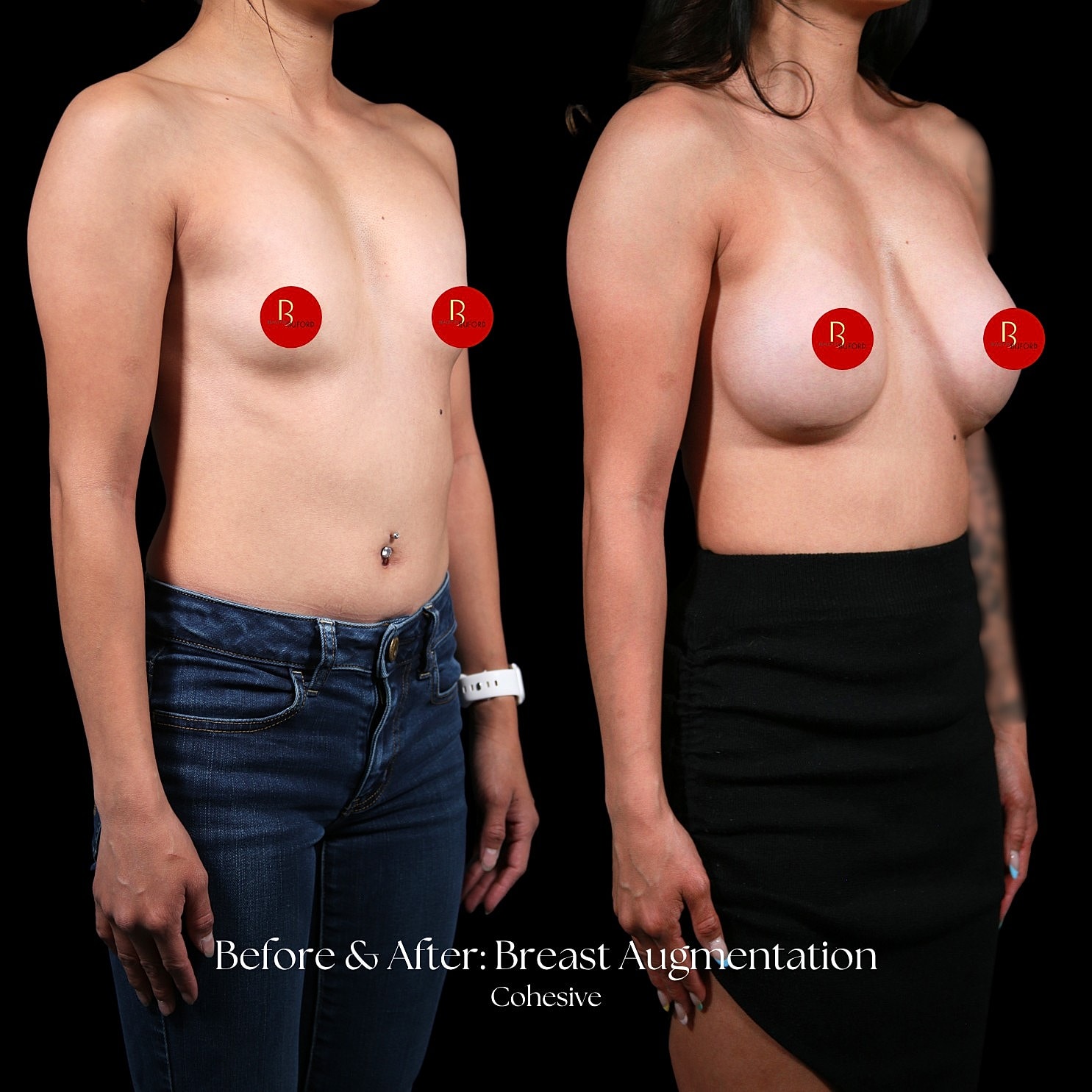 Breast Augmentation Before & After