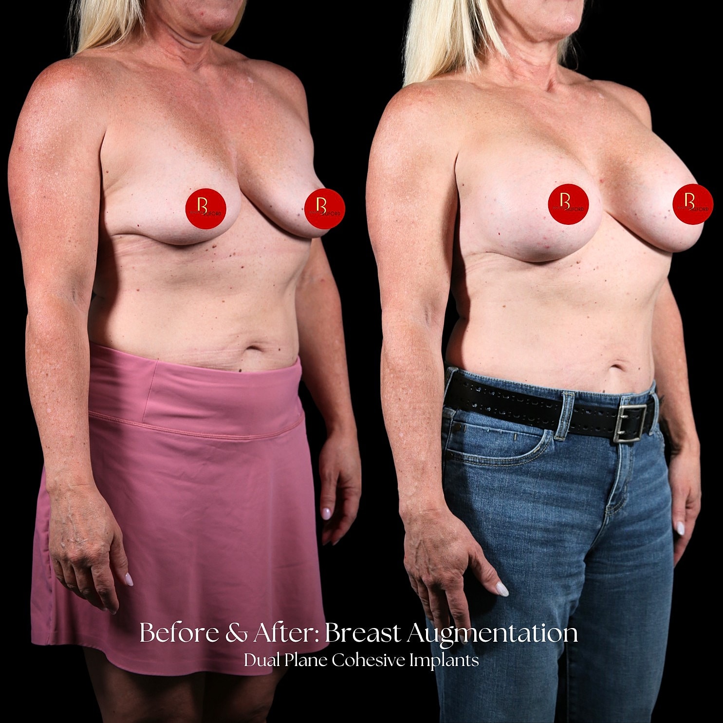 Breast Augmentation Before & After