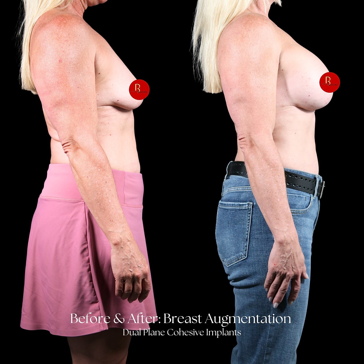 Breast Augmentation Before & After