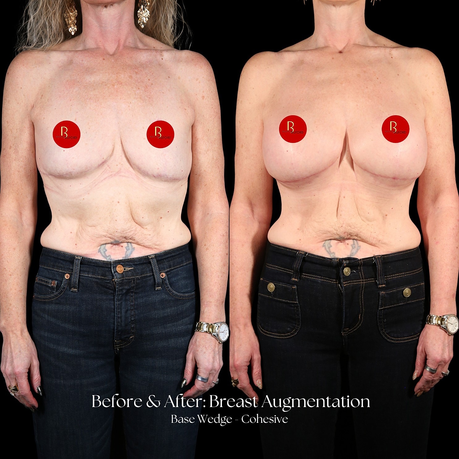 Breast Augmentation Before & After