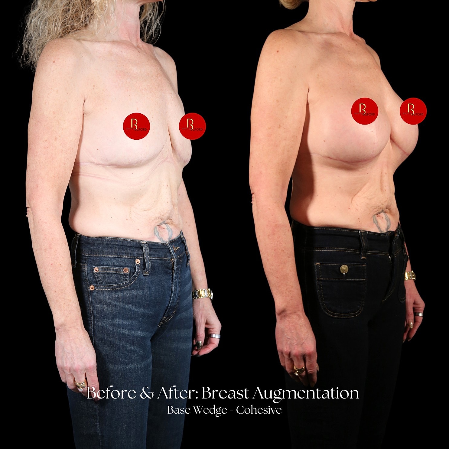 Breast Augmentation Before & After