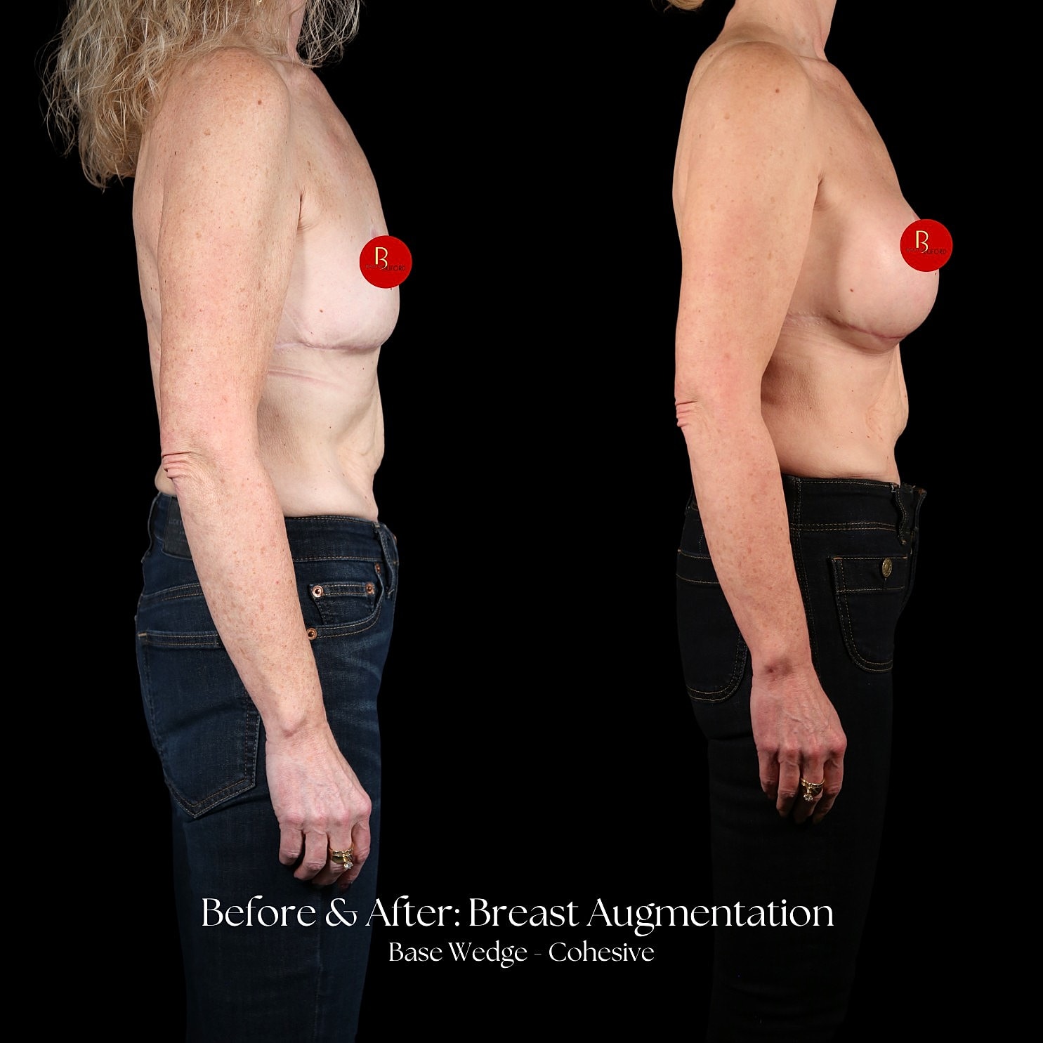 Breast Augmentation Before & After