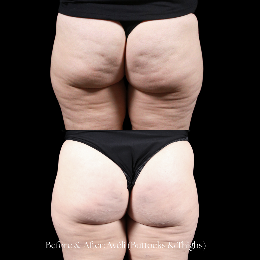 Aveli Before & After