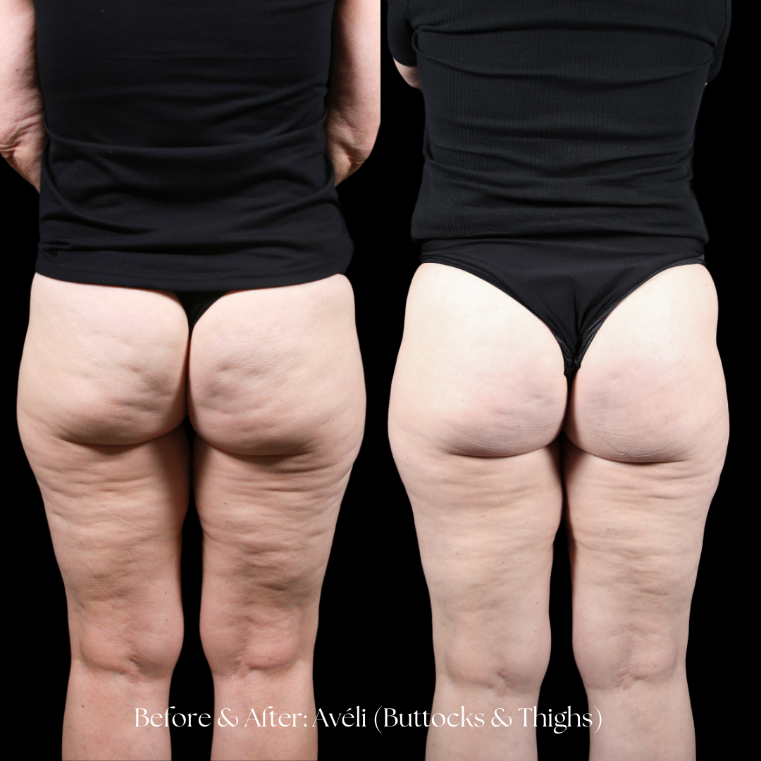 Aveli Before & After