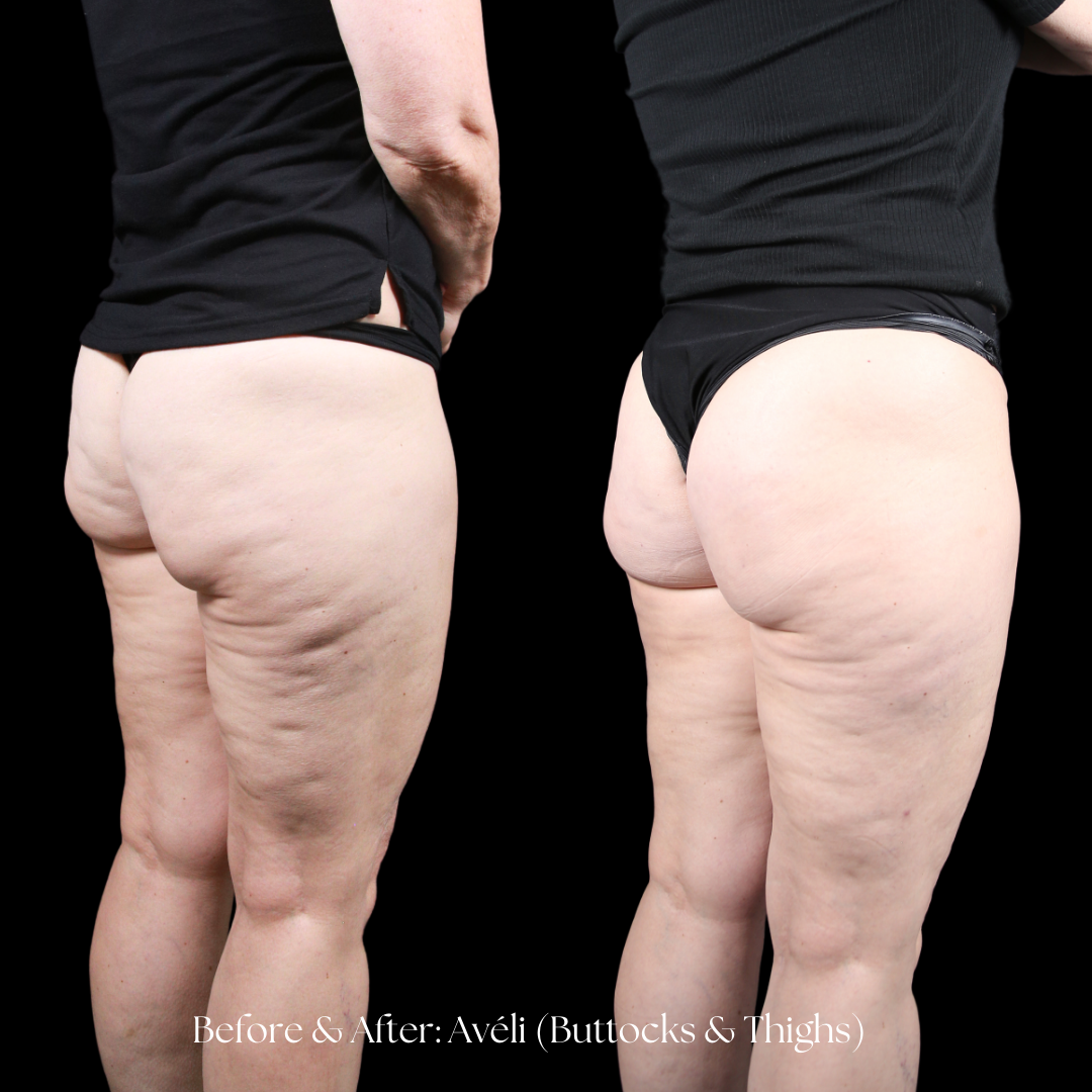 Aveli Before & After