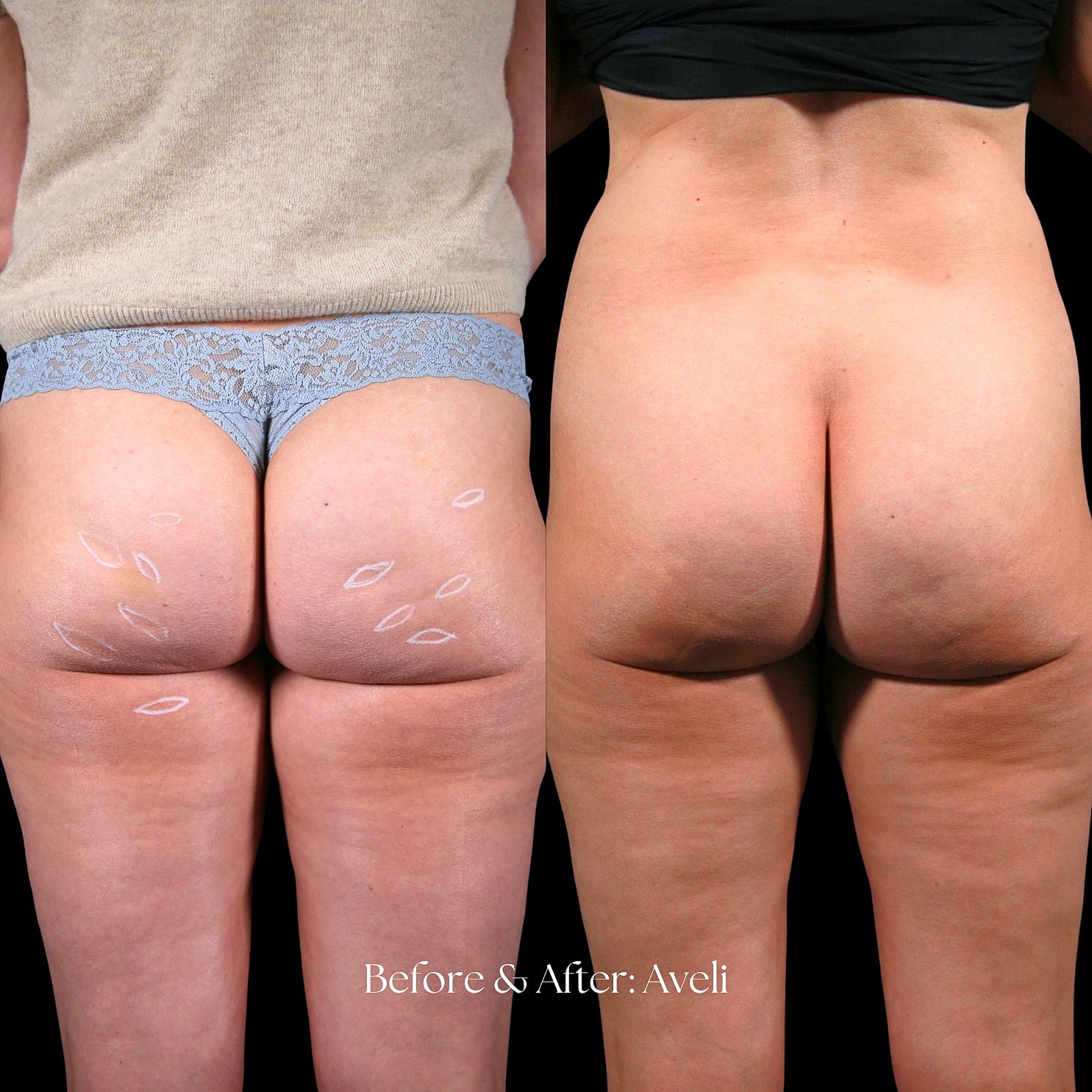 Aveli Before & After