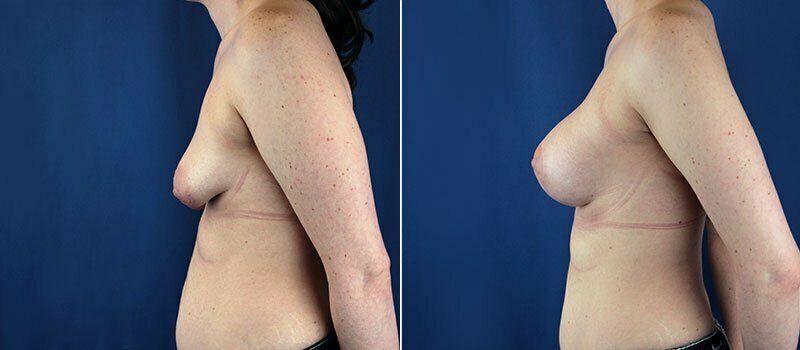 Breast Lift With Implants Before & After