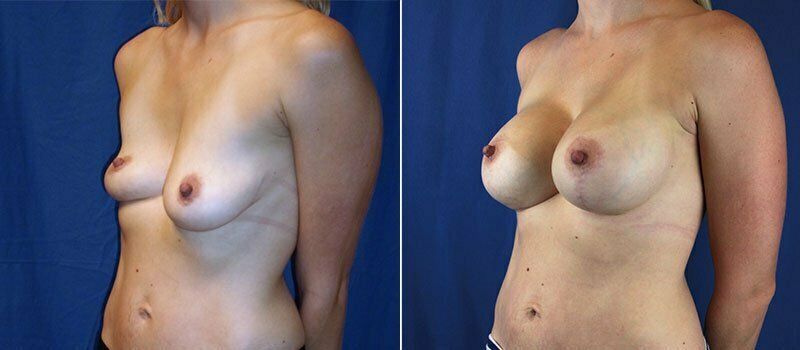 Breast Lift With Implants Before & After