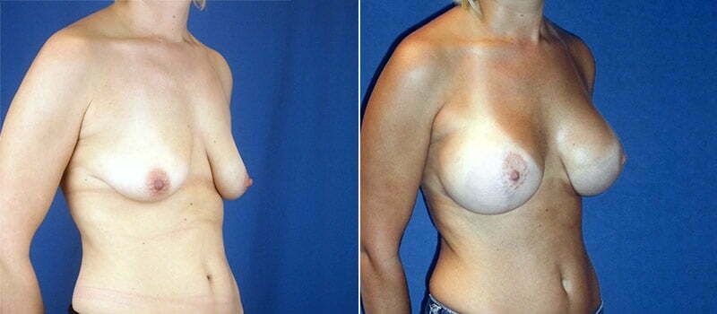 Breast Lift With Implants Before & After