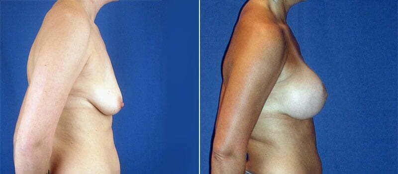 Breast Lift With Implants Before & After