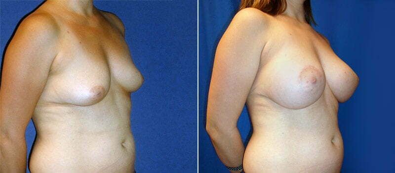 Breast Lift With Implants Before & After