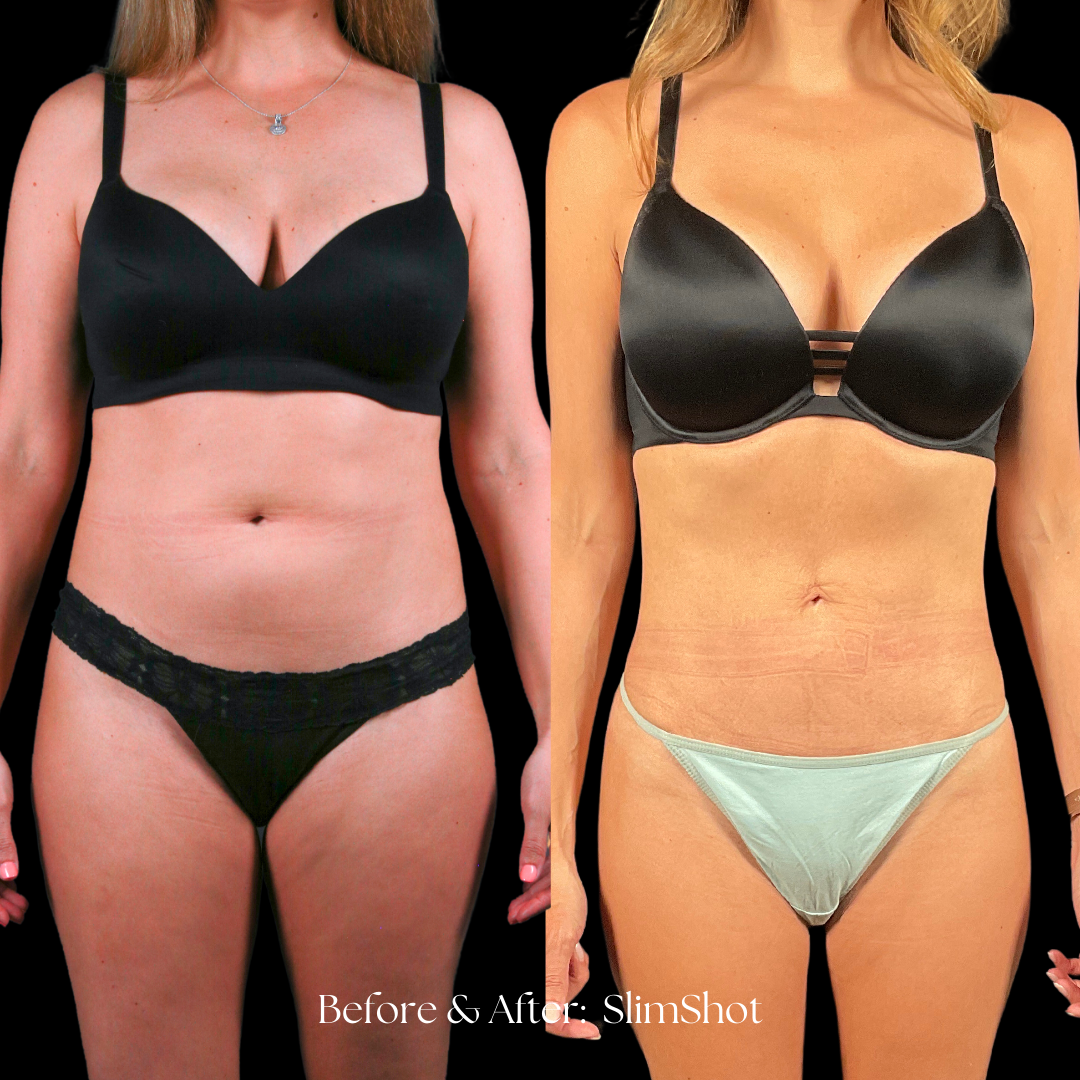 SlimShot Before & After