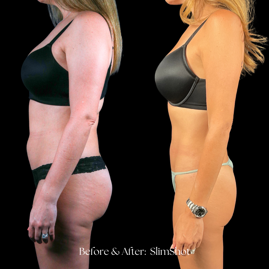 SlimShot Before & After