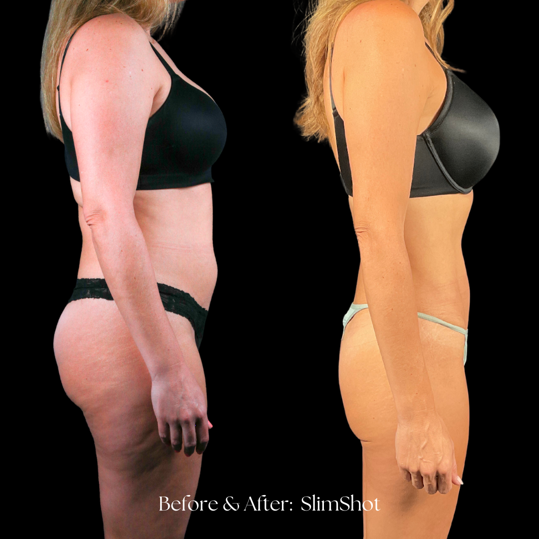 SlimShot Before & After