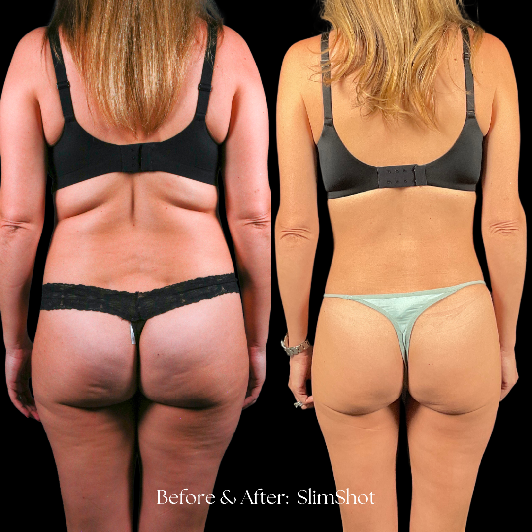 SlimShot Before & After