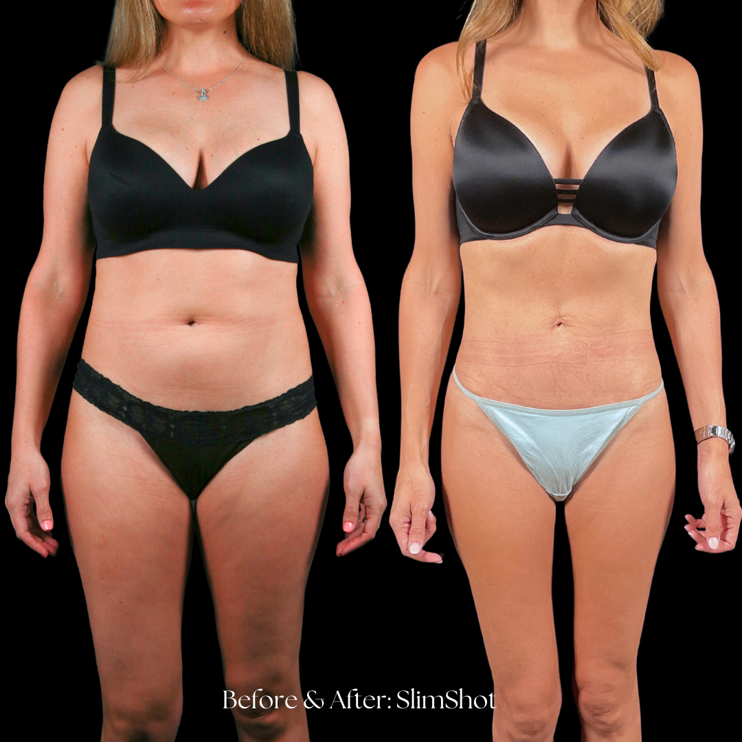 SlimShot Before & After
