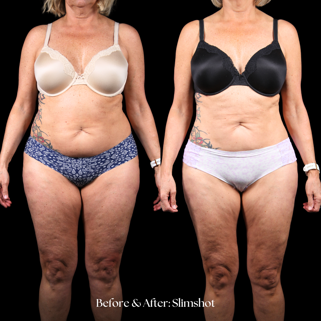 SlimShot Before & After