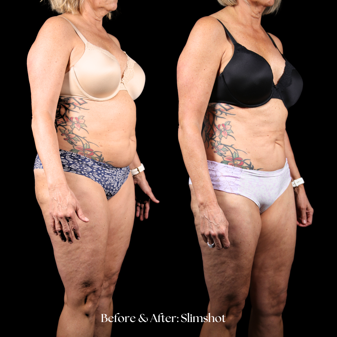 SlimShot Before & After