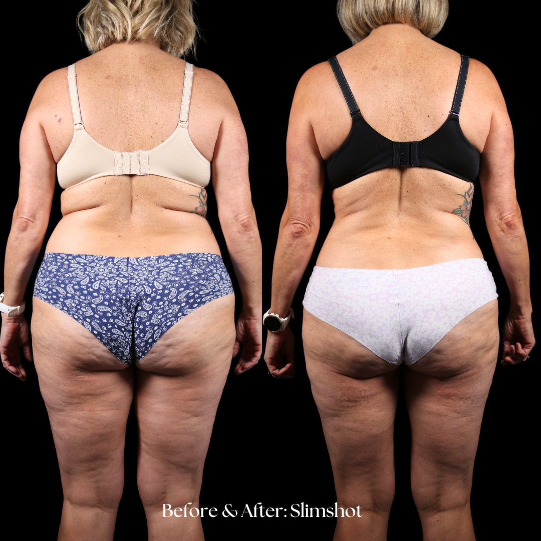 SlimShot Before & After