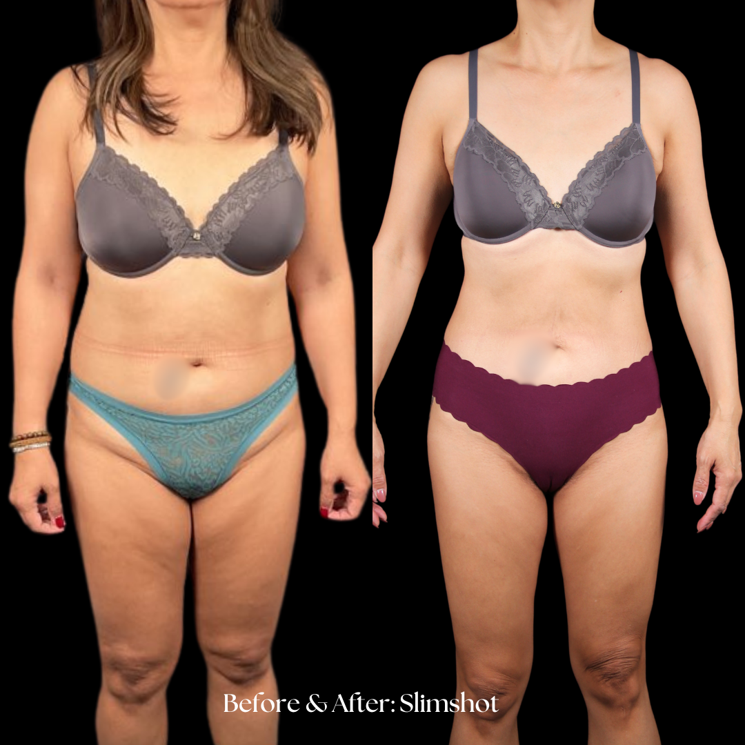 SlimShot Before & After