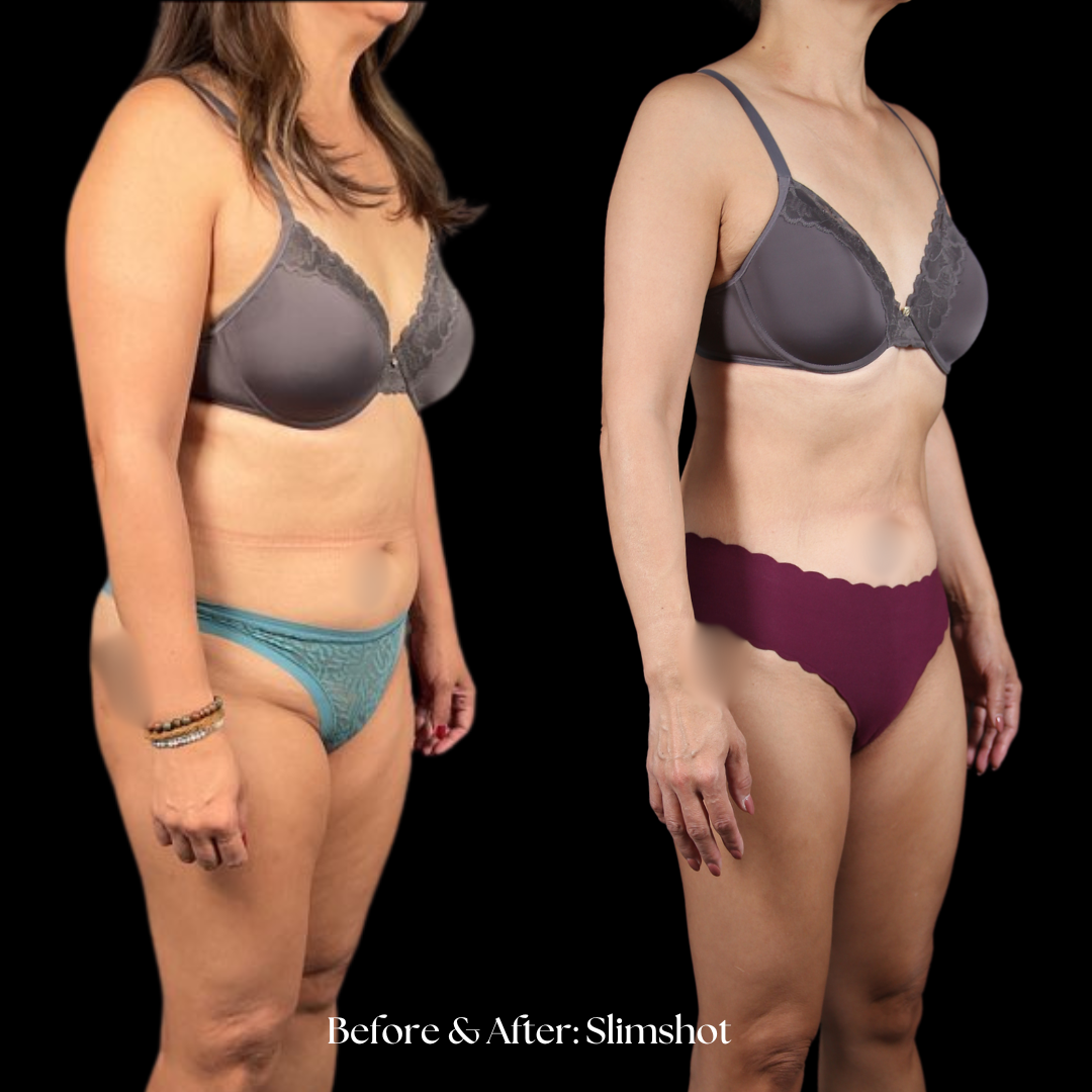 SlimShot Before & After