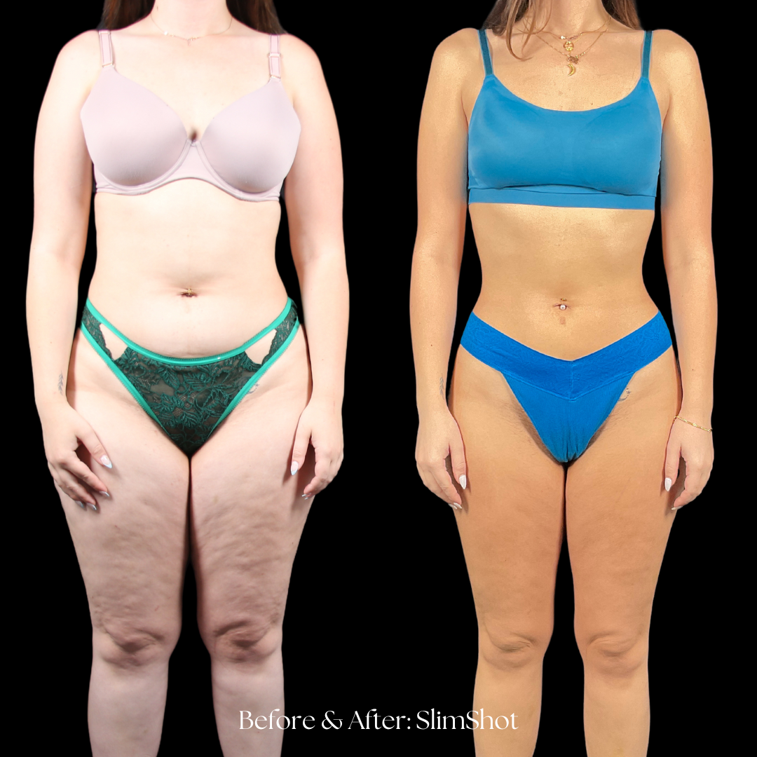 SlimShot Before & After