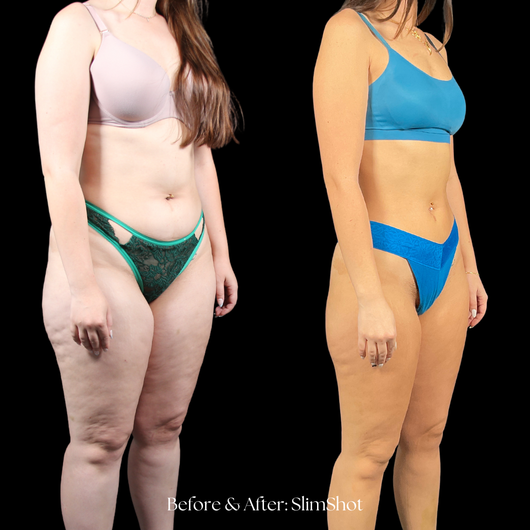 SlimShot Before & After