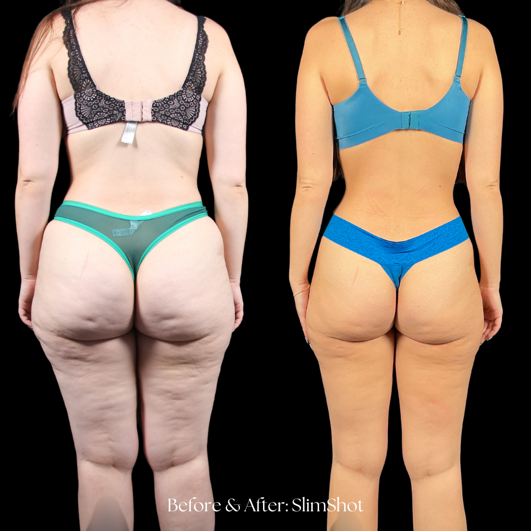 SlimShot Before & After
