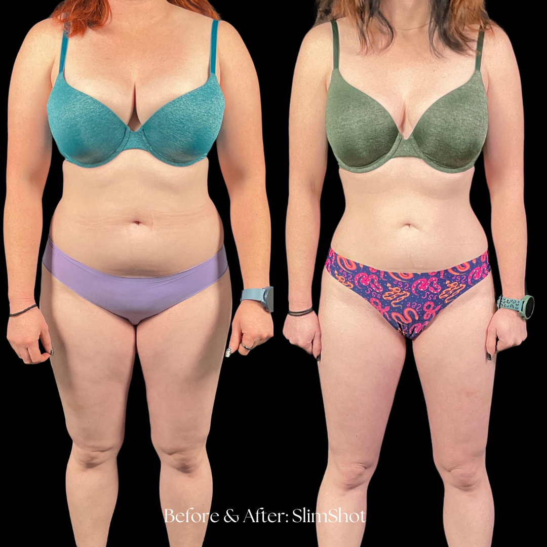 SlimShot Before & After