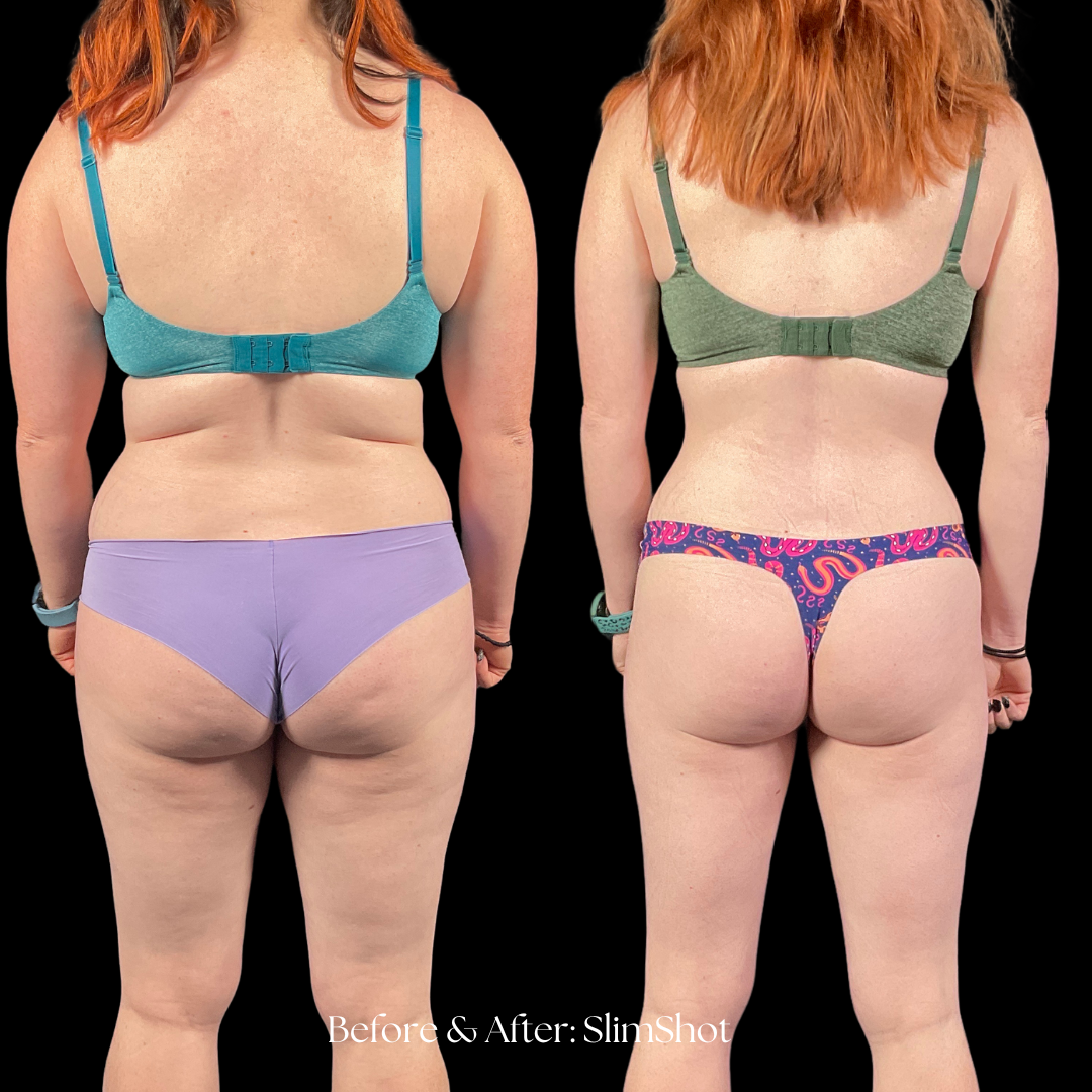SlimShot Before & After