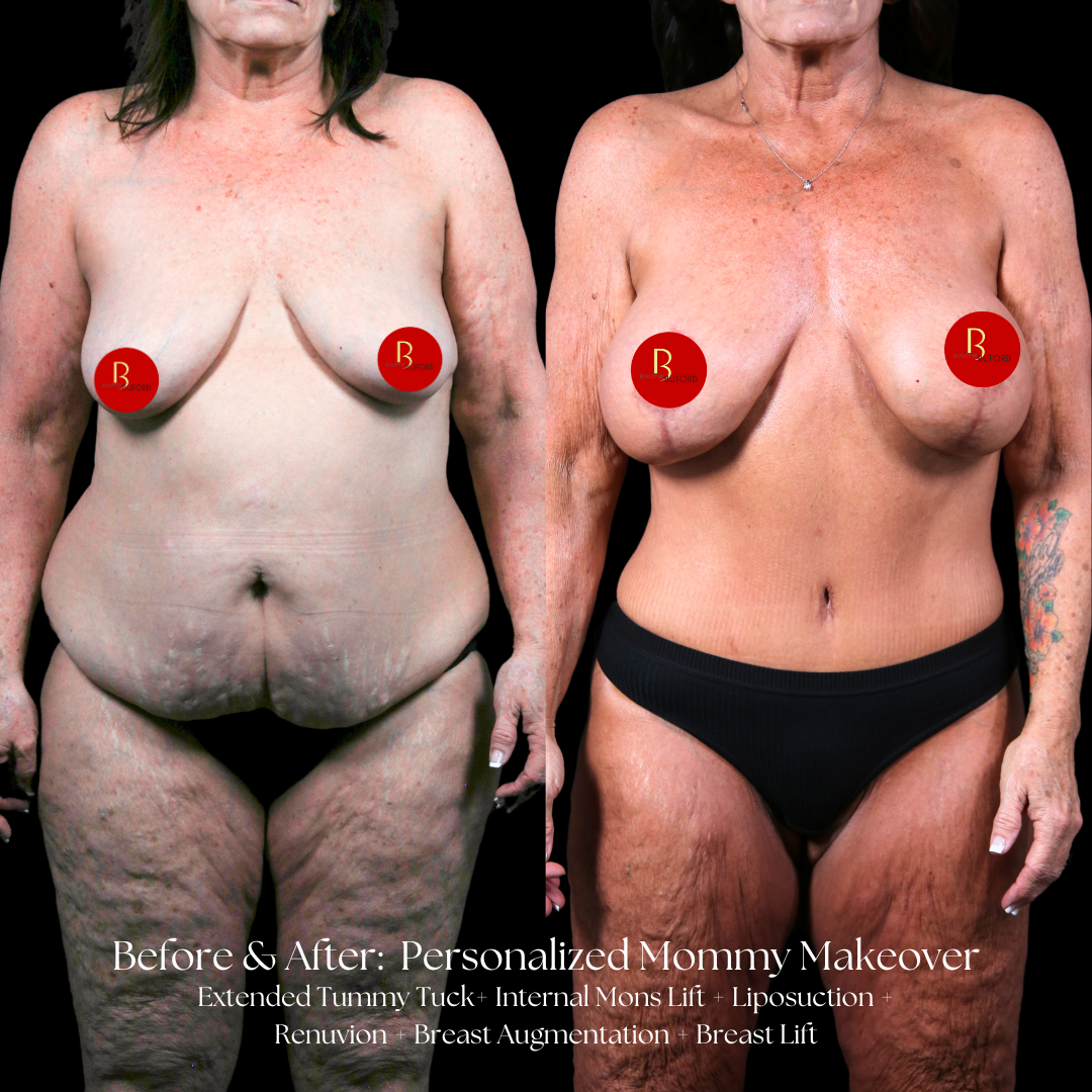 Mommy Makeover Before & After