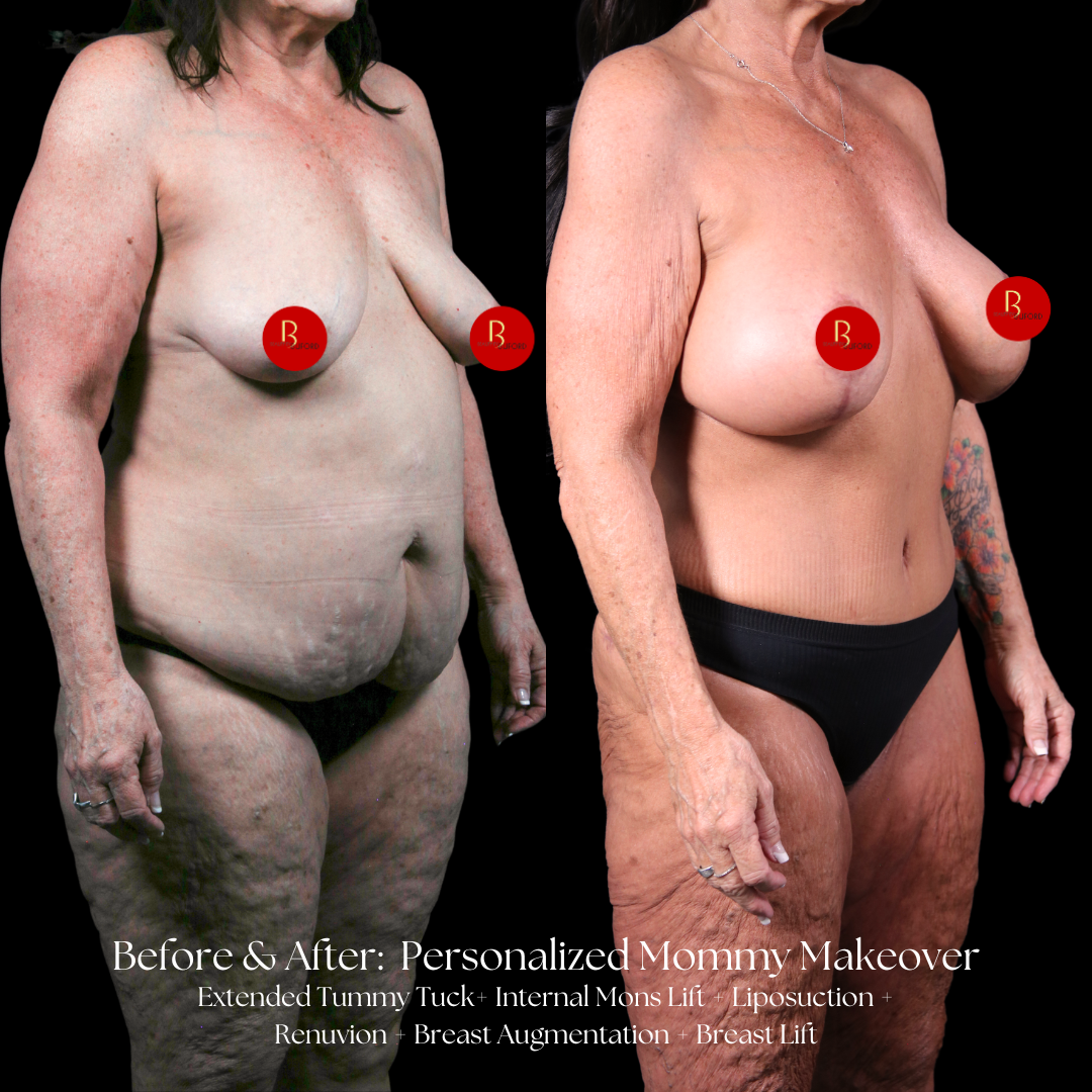 Mommy Makeover Before & After