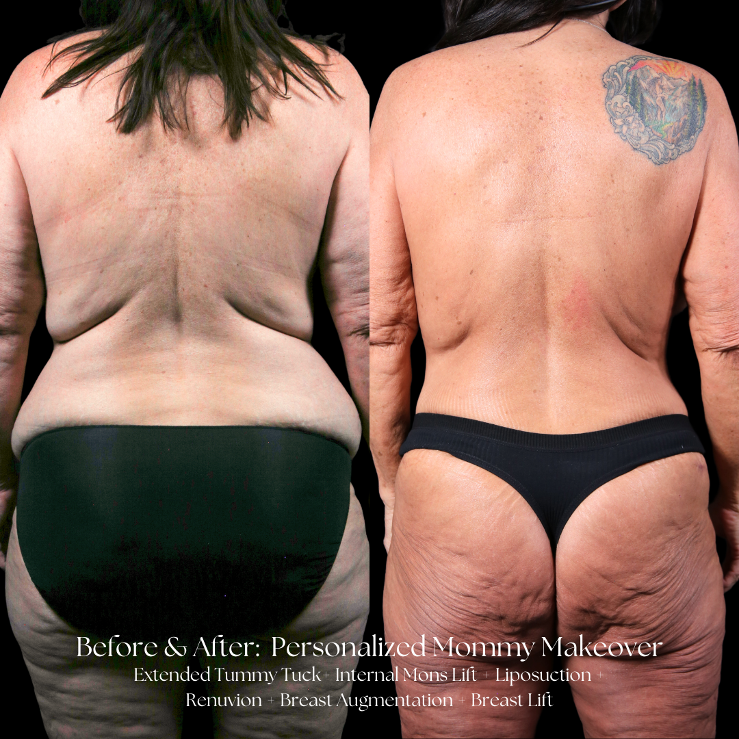 Mommy Makeover Before & After