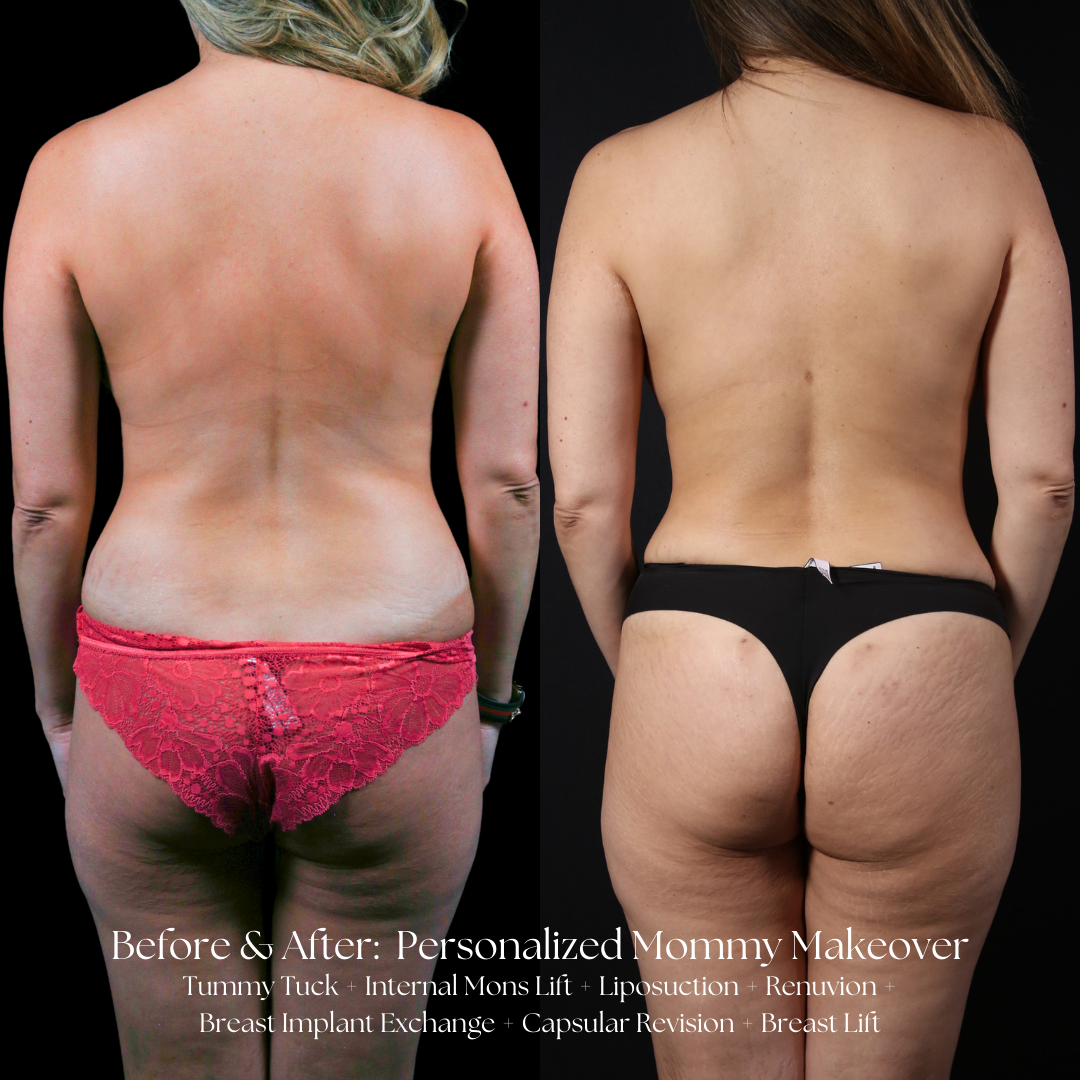 Mommy Makeover Before & After