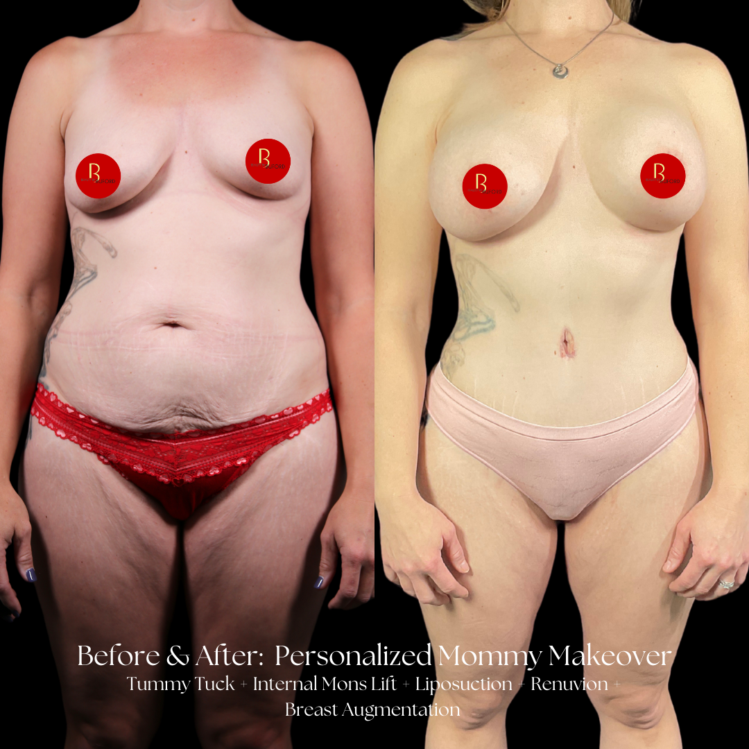 Mommy Makeover Before & After