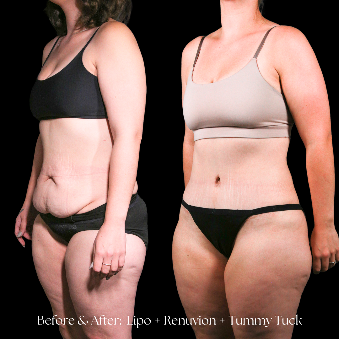 Tummy Tuck Before & After