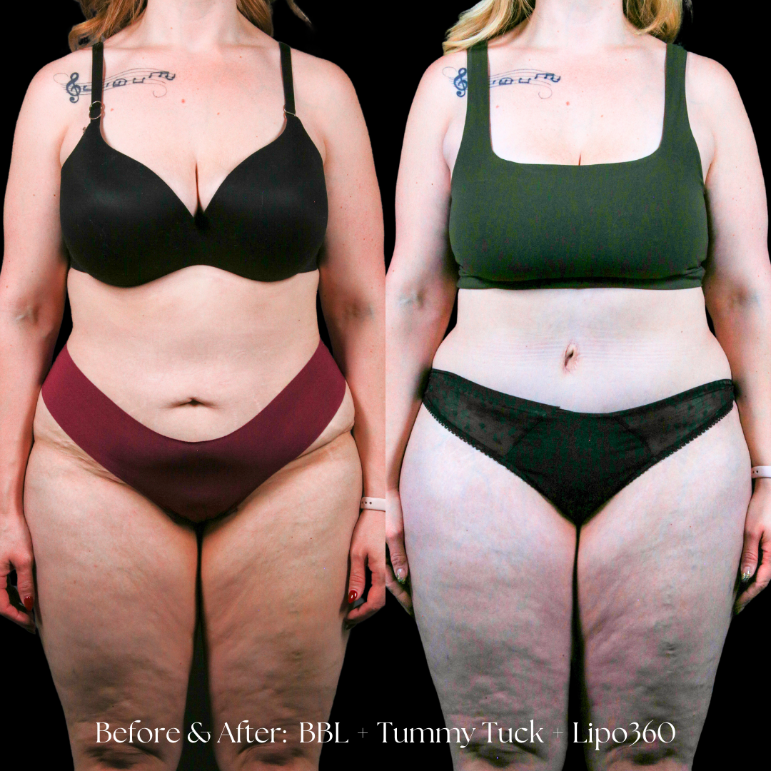 Tummy Tuck Before & After