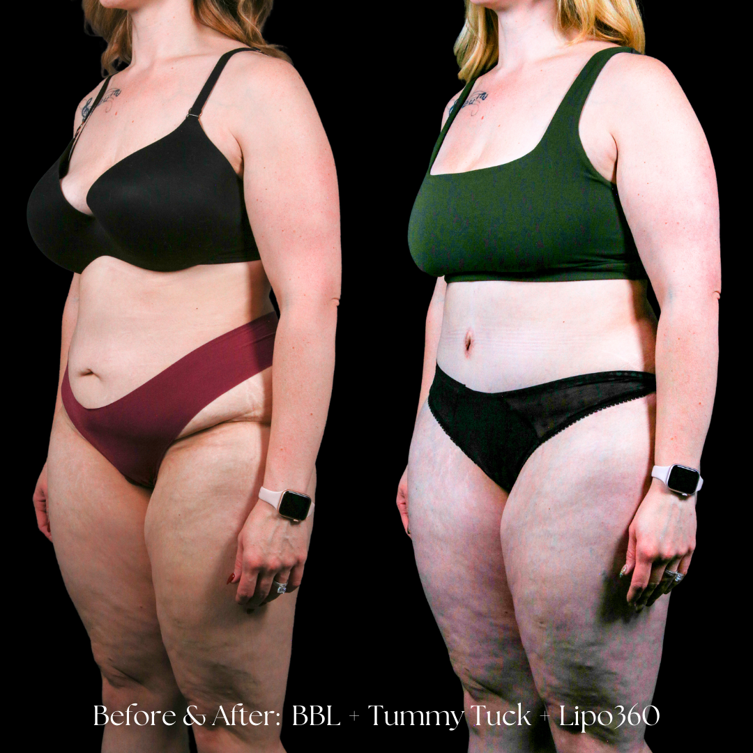 Tummy Tuck Before & After