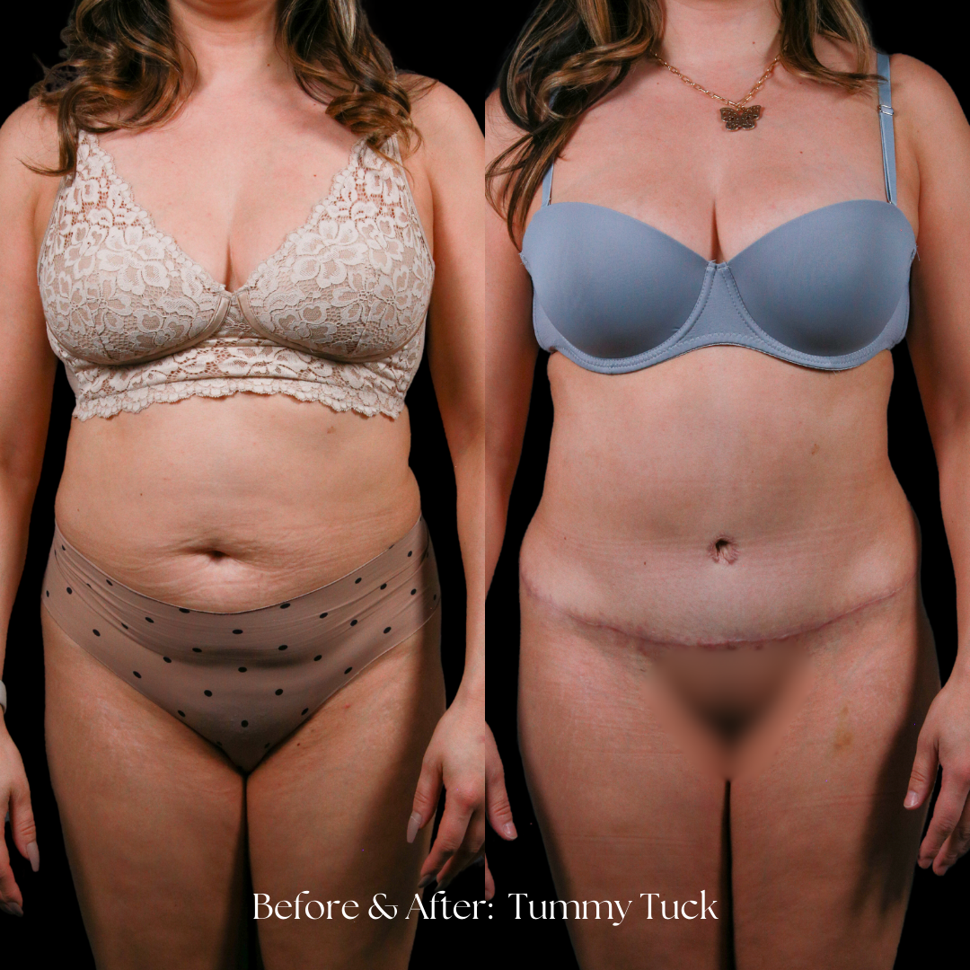 Tummy Tuck Before & After