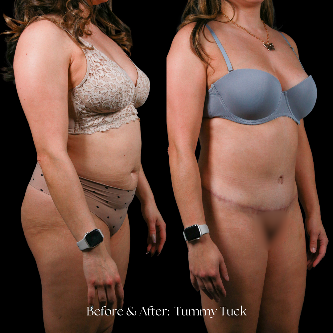 Tummy Tuck Before & After