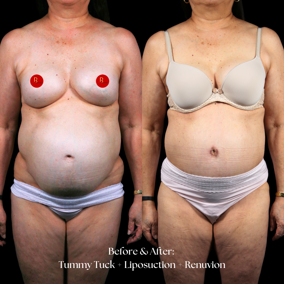 Tummy Tuck Before & After